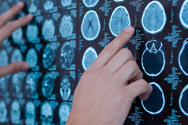 O impacto das doenças neurológicas na qualidade de vida e como a medicina pode ajudar